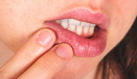 Cold Sores (Oral Herpes Labialis)