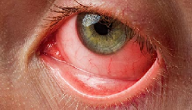 Pink Eye (Conjunctivitis)