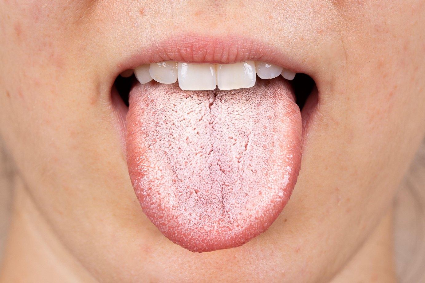 Oral Fungal Infection (Oral Thrush)