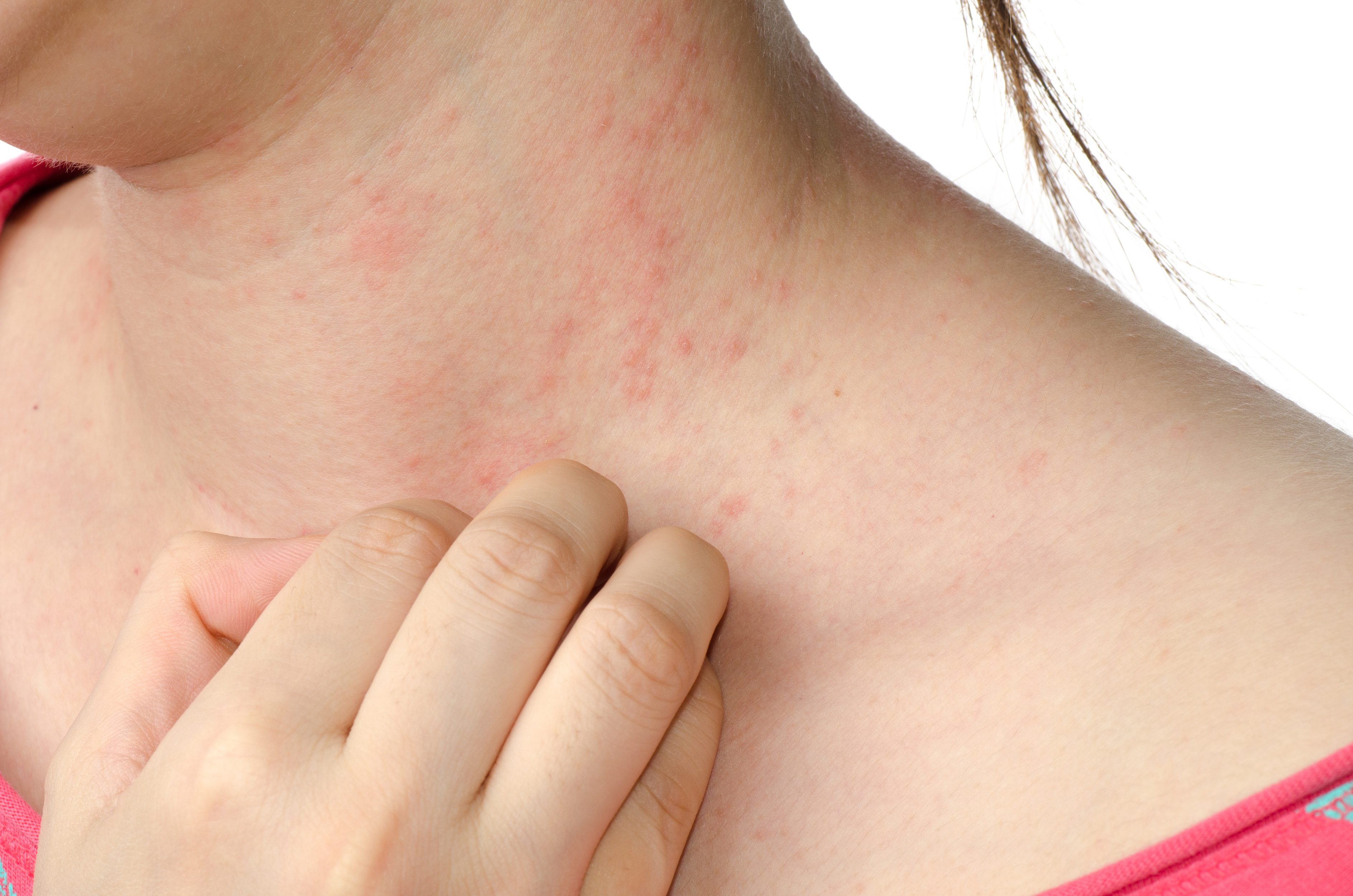 Skin Rash (Dermatitis)